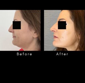 endolift results (2)