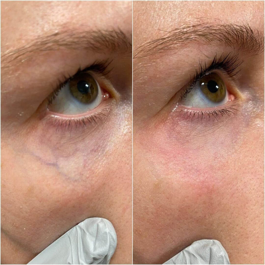 laser genesis image blog