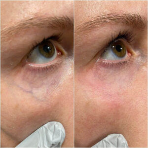 laser genesis image blog