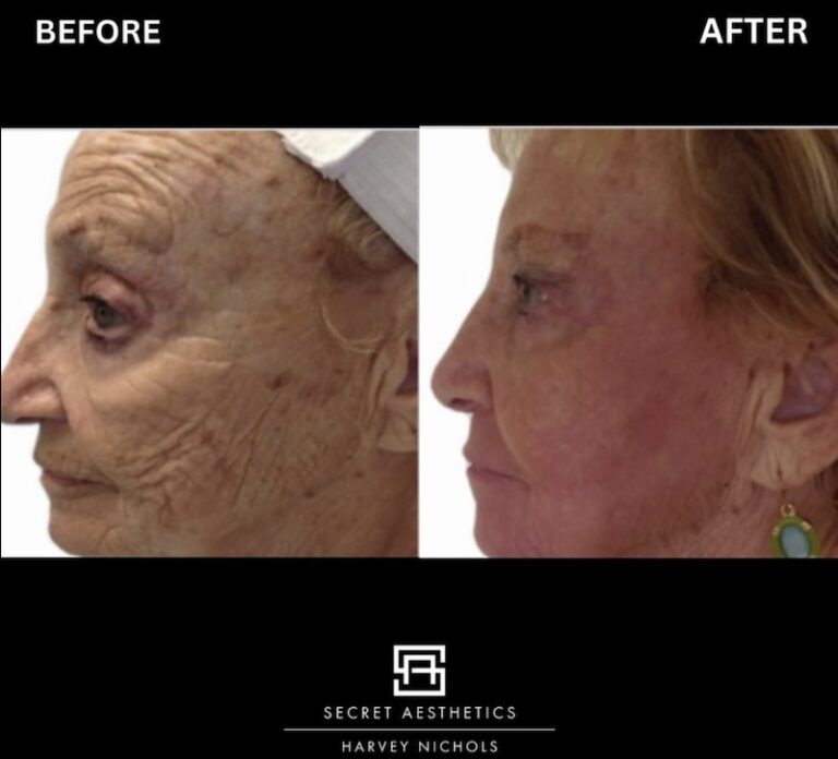 Before and after ablative Laser Resurfacing, Skin Resurfacing, Laser Resurfacing, CO2 Laser, wrinkle removal, sun damage removal, melasma removal, hyperpigmentation removal, scar removal, stretch mark removal, skin clinic, aesthetics clinic, birmingham, west midlands, east midlands, mailbox birmingham, harvey nichols birmingham, mailbox skin clinic, mailbox aesthetics clinic, harvey nichols skin clinic, harvey nichols aesthetics clinic Screenshot