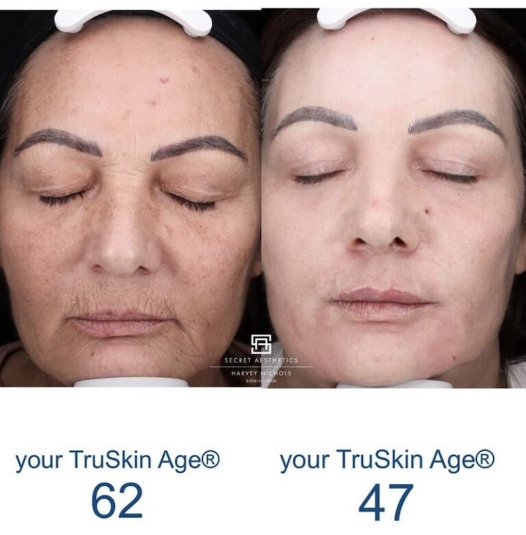 Before and after ablative Laser Resurfacing, Skin Resurfacing, Laser Resurfacing, CO2 Laser, wrinkle removal, sun damage removal, melasma removal, hyperpigmentation removal, scar removal, stretch mark removal, skin clinic, aesthetics clinic, birmingham, west midlands, east midlands, mailbox birmingham, harvey nichols birmingham, mailbox skin clinic, mailbox aesthetics clinic, harvey nichols skin clinic, harvey nichols aesthetics clinic Screenshot