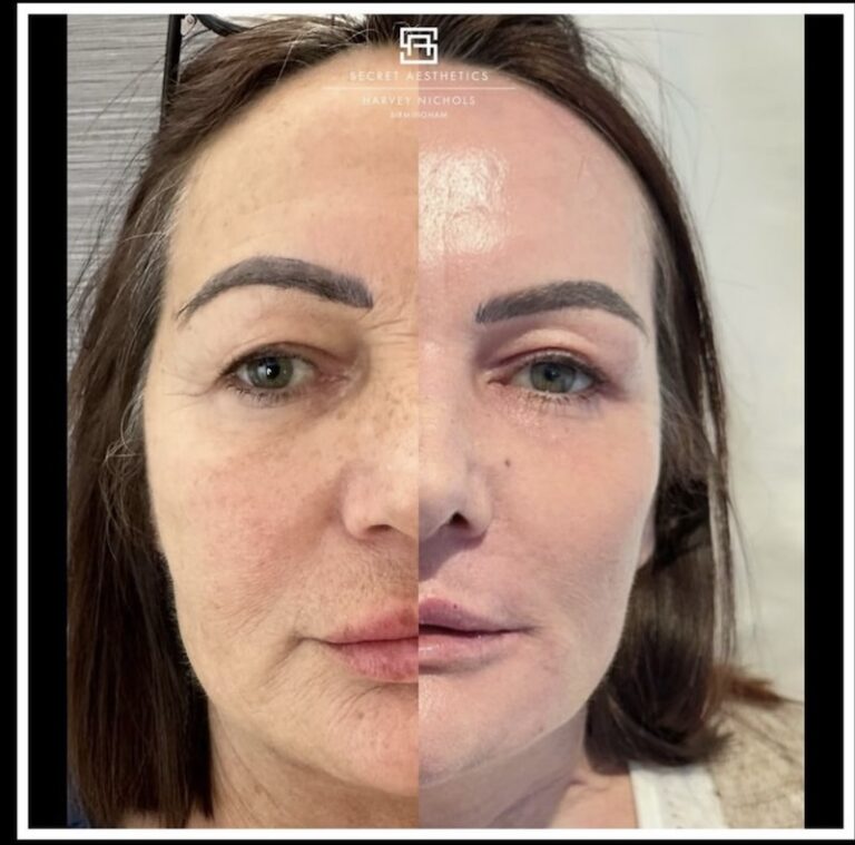 Before and after ablative Laser Resurfacing, Skin Resurfacing, Laser Resurfacing, CO2 Laser, wrinkle removal, sun damage removal, melasma removal, hyperpigmentation removal, scar removal, stretch mark removal, skin clinic, aesthetics clinic, birmingham, west midlands, east midlands, mailbox birmingham, harvey nichols birmingham, mailbox skin clinic, mailbox aesthetics clinic, harvey nichols skin clinic, harvey nichols aesthetics clinic Screenshot