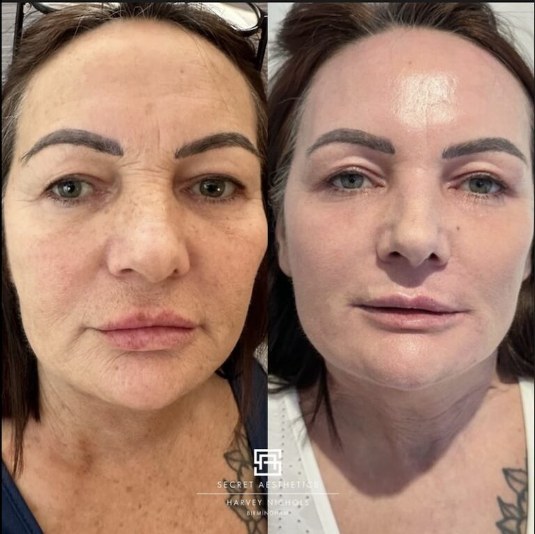 Before and after ablative Laser Resurfacing, Skin Resurfacing, Laser Resurfacing, CO2 Laser, wrinkle removal, sun damage removal, melasma removal, hyperpigmentation removal, scar removal, stretch mark removal, skin clinic, aesthetics clinic, birmingham, west midlands, east midlands, mailbox birmingham, harvey nichols birmingham, mailbox skin clinic, mailbox aesthetics clinic, harvey nichols skin clinic, harvey nichols aesthetics clinic Screenshot