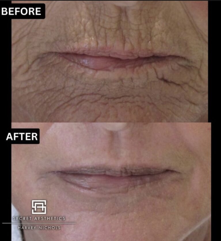 Before and after ablative Laser Resurfacing, Skin Resurfacing, Laser Resurfacing, CO2 Laser, wrinkle removal, sun damage removal, melasma removal, hyperpigmentation removal, scar removal, stretch mark removal, skin clinic, aesthetics clinic, birmingham, west midlands, east midlands, mailbox birmingham, harvey nichols birmingham, mailbox skin clinic, mailbox aesthetics clinic, harvey nichols skin clinic, harvey nichols aesthetics clinic Screenshot