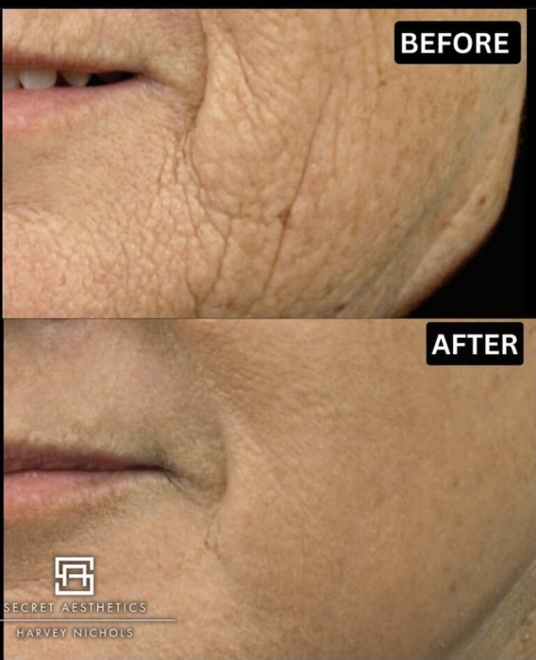 Before and after ablative Laser Resurfacing, Skin Resurfacing, Laser Resurfacing, CO2 Laser, wrinkle removal, sun damage removal, melasma removal, hyperpigmentation removal, scar removal, stretch mark removal, skin clinic, aesthetics clinic, birmingham, west midlands, east midlands, mailbox birmingham, harvey nichols birmingham, mailbox skin clinic, mailbox aesthetics clinic, harvey nichols skin clinic, harvey nichols aesthetics clinic Screenshot