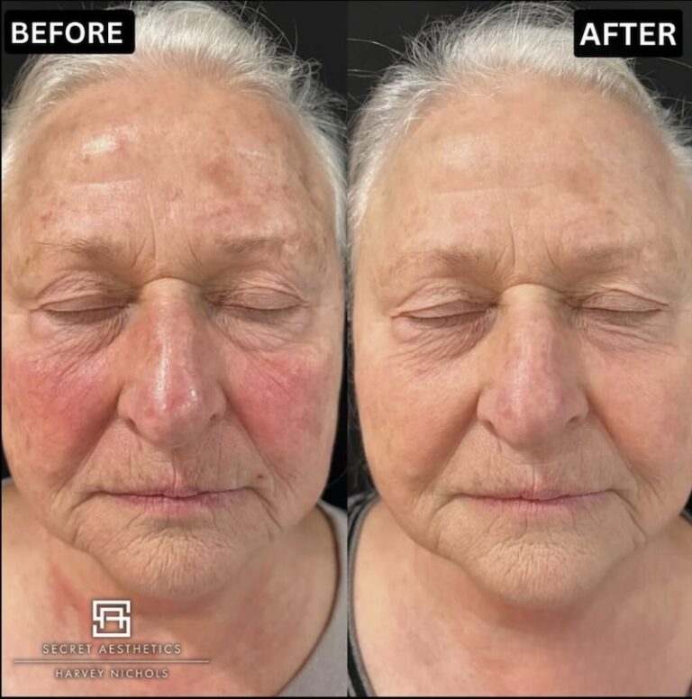 Before and after ablative Laser Resurfacing, Skin Resurfacing, Laser Resurfacing, CO2 Laser, wrinkle removal, sun damage removal, melasma removal, hyperpigmentation removal, scar removal, stretch mark removal, skin clinic, aesthetics clinic, birmingham, west midlands, east midlands, mailbox birmingham, harvey nichols birmingham, mailbox skin clinic, mailbox aesthetics clinic, harvey nichols skin clinic, harvey nichols aesthetics clinic Screenshot