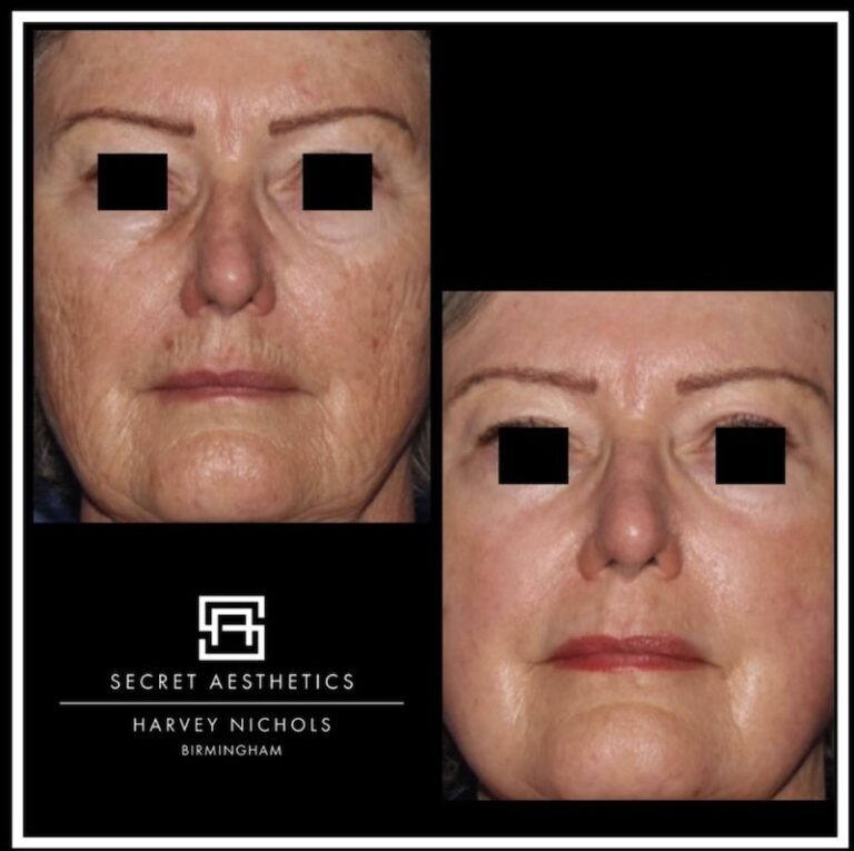 Before and after ablative Laser Resurfacing, Skin Resurfacing, Laser Resurfacing, CO2 Laser, wrinkle removal, sun damage removal, melasma removal, hyperpigmentation removal, scar removal, stretch mark removal, skin clinic, aesthetics clinic, birmingham, west midlands, east midlands, mailbox birmingham, harvey nichols birmingham, mailbox skin clinic, mailbox aesthetics clinic, harvey nichols skin clinic, harvey nichols aesthetics clinic Screenshot