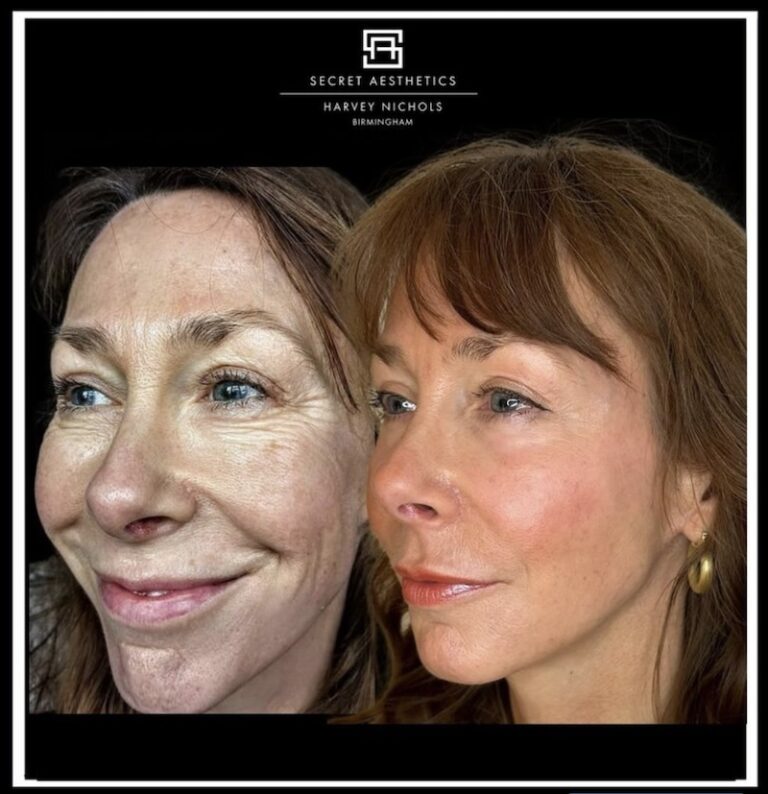 Before and after ablative Laser Resurfacing, Skin Resurfacing, Laser Resurfacing, CO2 Laser, wrinkle removal, sun damage removal, melasma removal, hyperpigmentation removal, scar removal, stretch mark removal, skin clinic, aesthetics clinic, birmingham, west midlands, east midlands, mailbox birmingham, harvey nichols birmingham, mailbox skin clinic, mailbox aesthetics clinic, harvey nichols skin clinic, harvey nichols aesthetics clinic Screenshot
