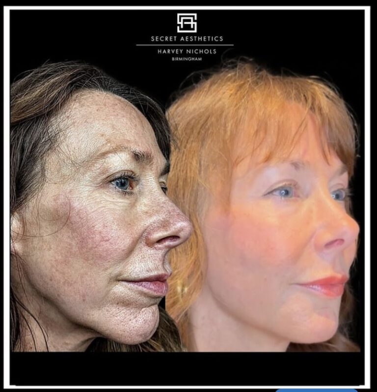 Before and after ablative Laser Resurfacing, Skin Resurfacing, Laser Resurfacing, CO2 Laser, wrinkle removal, sun damage removal, melasma removal, hyperpigmentation removal, scar removal, stretch mark removal, skin clinic, aesthetics clinic, birmingham, west midlands, east midlands, mailbox birmingham, harvey nichols birmingham, mailbox skin clinic, mailbox aesthetics clinic, harvey nichols skin clinic, harvey nichols aesthetics clinic Screenshot
