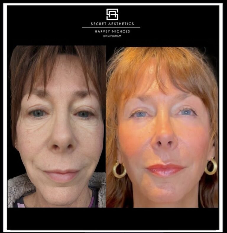 Before and after ablative Laser Resurfacing, Skin Resurfacing, Laser Resurfacing, CO2 Laser, wrinkle removal, sun damage removal, melasma removal, hyperpigmentation removal, scar removal, stretch mark removal, skin clinic, aesthetics clinic, birmingham, west midlands, east midlands, mailbox birmingham, harvey nichols birmingham, mailbox skin clinic, mailbox aesthetics clinic, harvey nichols skin clinic, harvey nichols aesthetics clinic Screenshot