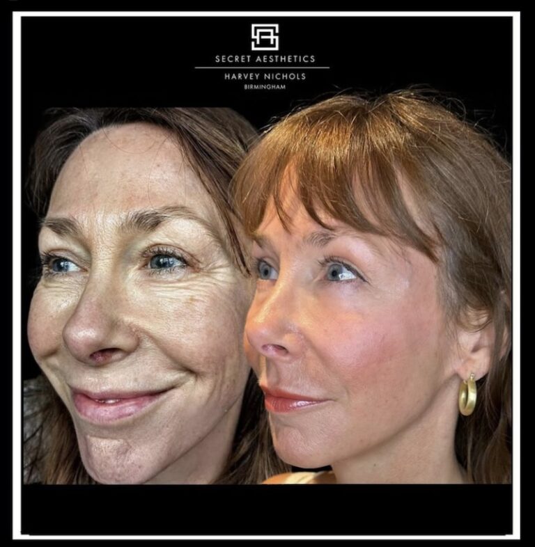 Before and after ablative Laser Resurfacing, Skin Resurfacing, Laser Resurfacing, CO2 Laser, wrinkle removal, sun damage removal, melasma removal, hyperpigmentation removal, scar removal, stretch mark removal, skin clinic, aesthetics clinic, birmingham, west midlands, east midlands, mailbox birmingham, harvey nichols birmingham, mailbox skin clinic, mailbox aesthetics clinic, harvey nichols skin clinic, harvey nichols aesthetics clinic Screenshot