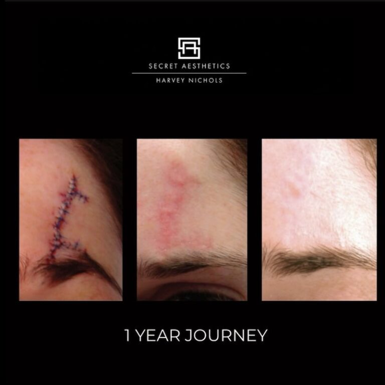 Before and after ablative Laser Resurfacing, Skin Resurfacing, Laser Resurfacing, CO2 Laser, wrinkle removal, sun damage removal, melasma removal, hyperpigmentation removal, scar removal, stretch mark removal, skin clinic, aesthetics clinic, birmingham, west midlands, east midlands, mailbox birmingham, harvey nichols birmingham, mailbox skin clinic, mailbox aesthetics clinic, harvey nichols skin clinic, harvey nichols aesthetics clinic Screenshot