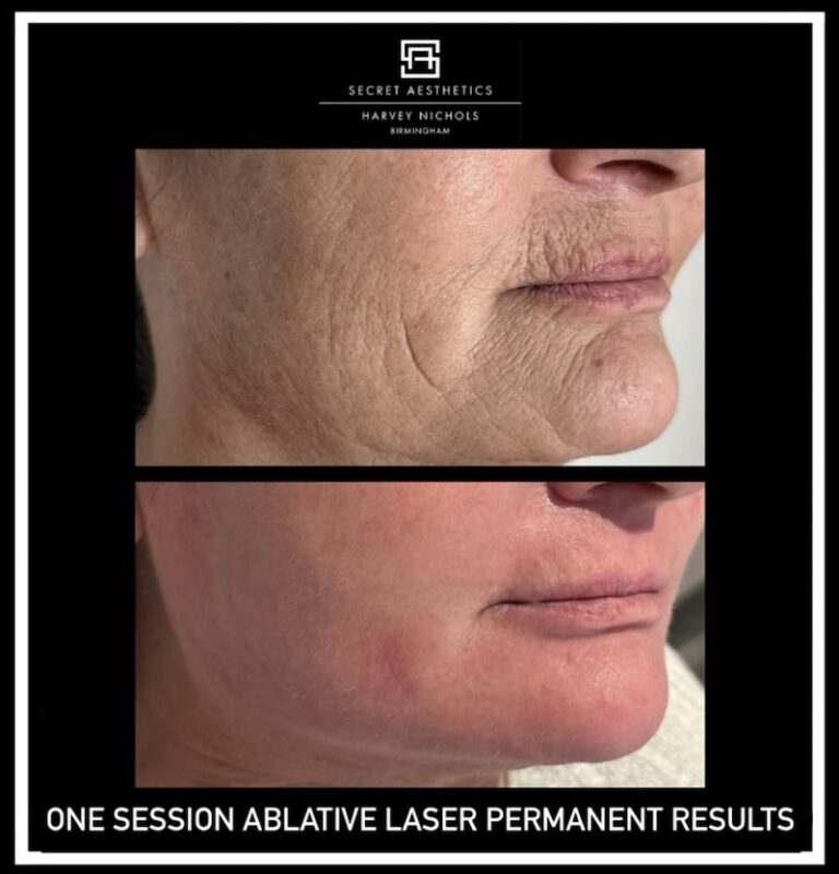 Before and after ablative Laser Resurfacing, Skin Resurfacing, Laser Resurfacing, CO2 Laser, wrinkle removal, sun damage removal, melasma removal, hyperpigmentation removal, scar removal, stretch mark removal, skin clinic, aesthetics clinic, birmingham, west midlands, east midlands, mailbox birmingham, harvey nichols birmingham, mailbox skin clinic, mailbox aesthetics clinic, harvey nichols skin clinic, harvey nichols aesthetics clinic Screenshot