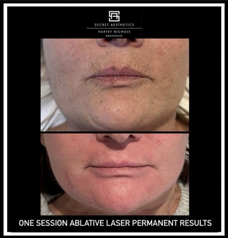 Before and after ablative Laser Resurfacing, Skin Resurfacing, Laser Resurfacing, CO2 Laser, wrinkle removal, sun damage removal, melasma removal, hyperpigmentation removal, scar removal, stretch mark removal, skin clinic, aesthetics clinic, birmingham, west midlands, east midlands, mailbox birmingham, harvey nichols birmingham, mailbox skin clinic, mailbox aesthetics clinic, harvey nichols skin clinic, harvey nichols aesthetics clinic Screenshot