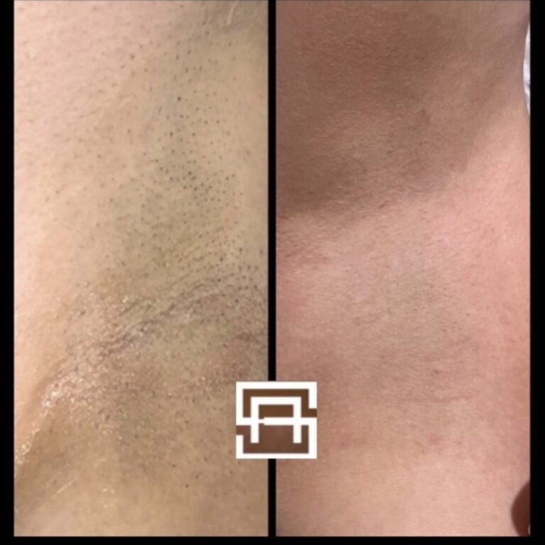 Laser hair removal before and after armpit hair removal birmingham, secret aesthetics, mailbox laser clinic, harvey nichols laser clinic, laser clinic birmingham, laser hair removal birmingham Screenshot
