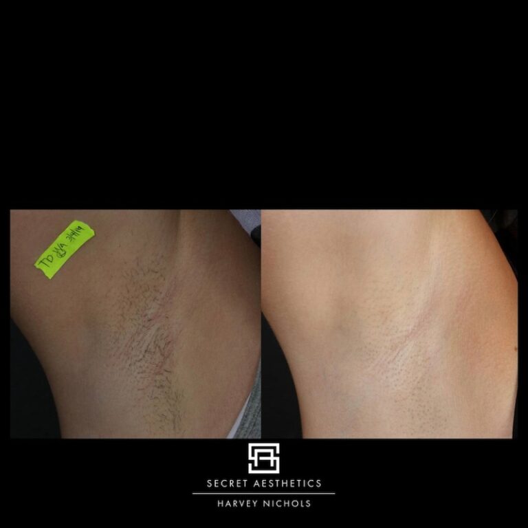 Laser hair removal before and after armpit hair removal birmingham, secret aesthetics, mailbox laser clinic, harvey nichols laser clinic, laser clinic birmingham, laser hair removal birmingham