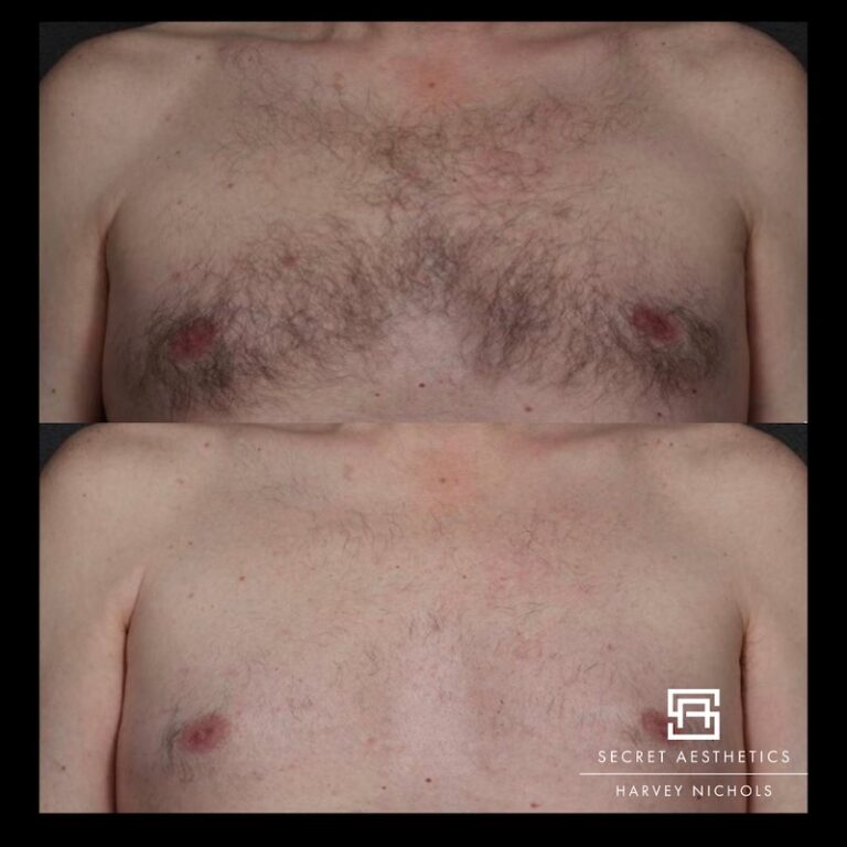 Laser hair removal before and after mens chest hair removal birmingham, secret aesthetics, mailbox laser clinic, harvey nichols laser clinic, laser clinic birmingham, laser hair removal birmingham