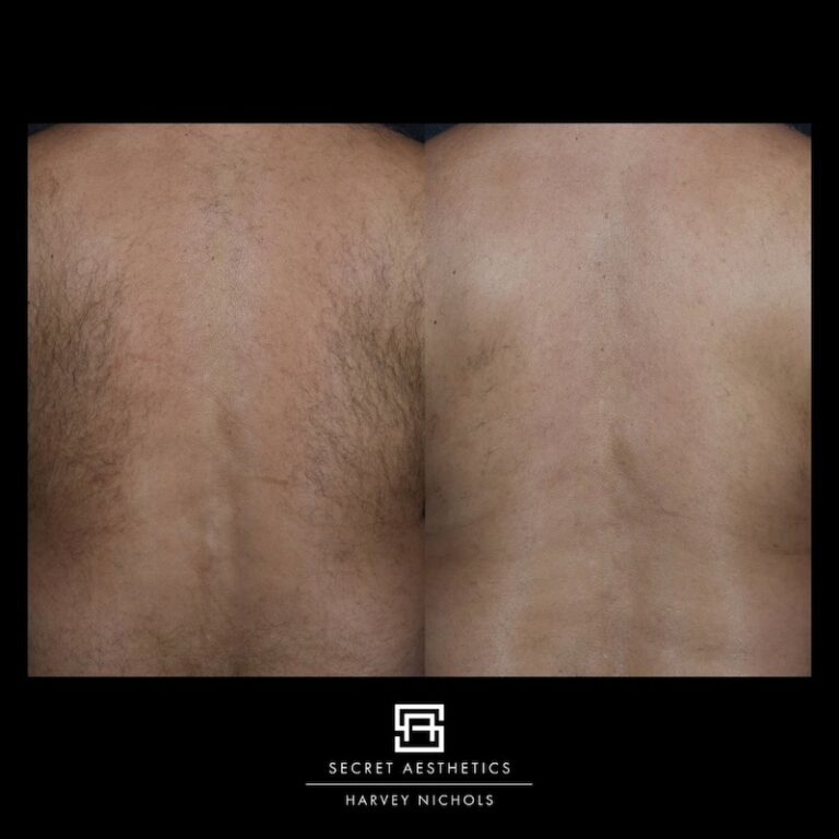 Laser hair removal before and after mens back hair removal birmingham, secret aesthetics, mailbox laser clinic, harvey nichols laser clinic, laser clinic birmingham, laser hair removal birmingham