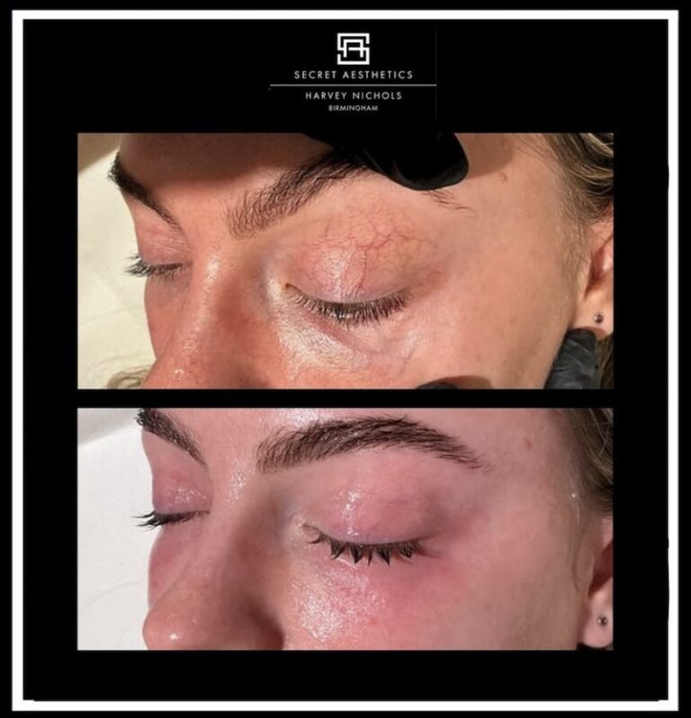 Periorbital Vein Removal In Birmingham before and after, vein removal, eye vein removal, veins around the eyes removal, secret aesthetics birmingham, harvey nichols skin clinic birmingham, the mailbox aesthetics clinic, the mailbox skin clinic, eye clinic, aesthetics clinic birmingham, skin clinic birmingham, east midlands