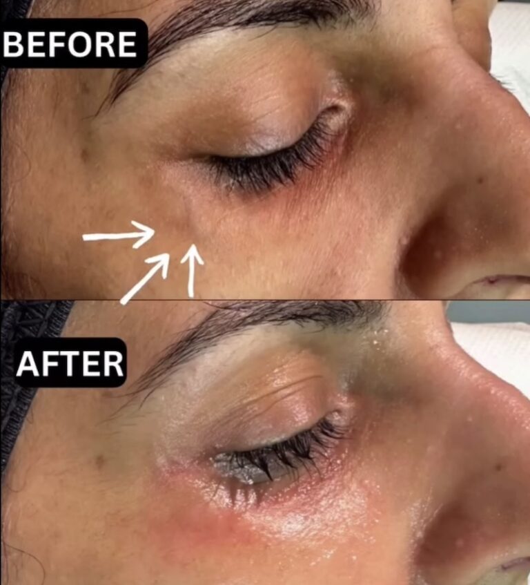 Periorbital Vein Removal In Birmingham before and after, vein removal, eye vein removal, veins around the eyes removal, secret aesthetics birmingham, harvey nichols skin clinic birmingham, the mailbox aesthetics clinic, the mailbox skin clinic, eye clinic, aesthetics clinic birmingham, skin clinic birmingham, east midlands Screenshot