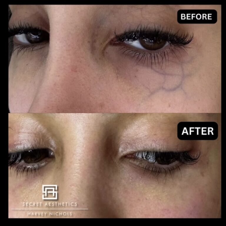Periorbital Vein Removal In Birmingham before and after, vein removal, eye vein removal, veins around the eyes removal, secret aesthetics birmingham, harvey nichols skin clinic birmingham, the mailbox aesthetics clinic, the mailbox skin clinic, eye clinic, aesthetics clinic birmingham, skin clinic birmingham, east midlands Screenshot