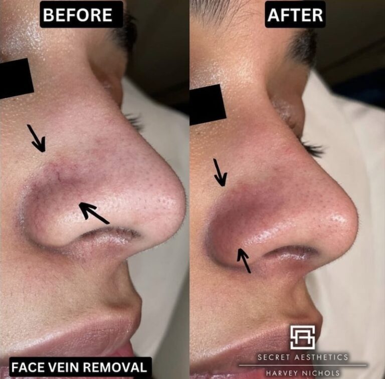 Periorbital Vein Removal In Birmingham before and after, vein removal, eye vein removal, veins around the eyes removal, secret aesthetics birmingham, harvey nichols skin clinic birmingham, the mailbox aesthetics clinic, the mailbox skin clinic, eye clinic, aesthetics clinic birmingham, skin clinic birmingham, east midlands