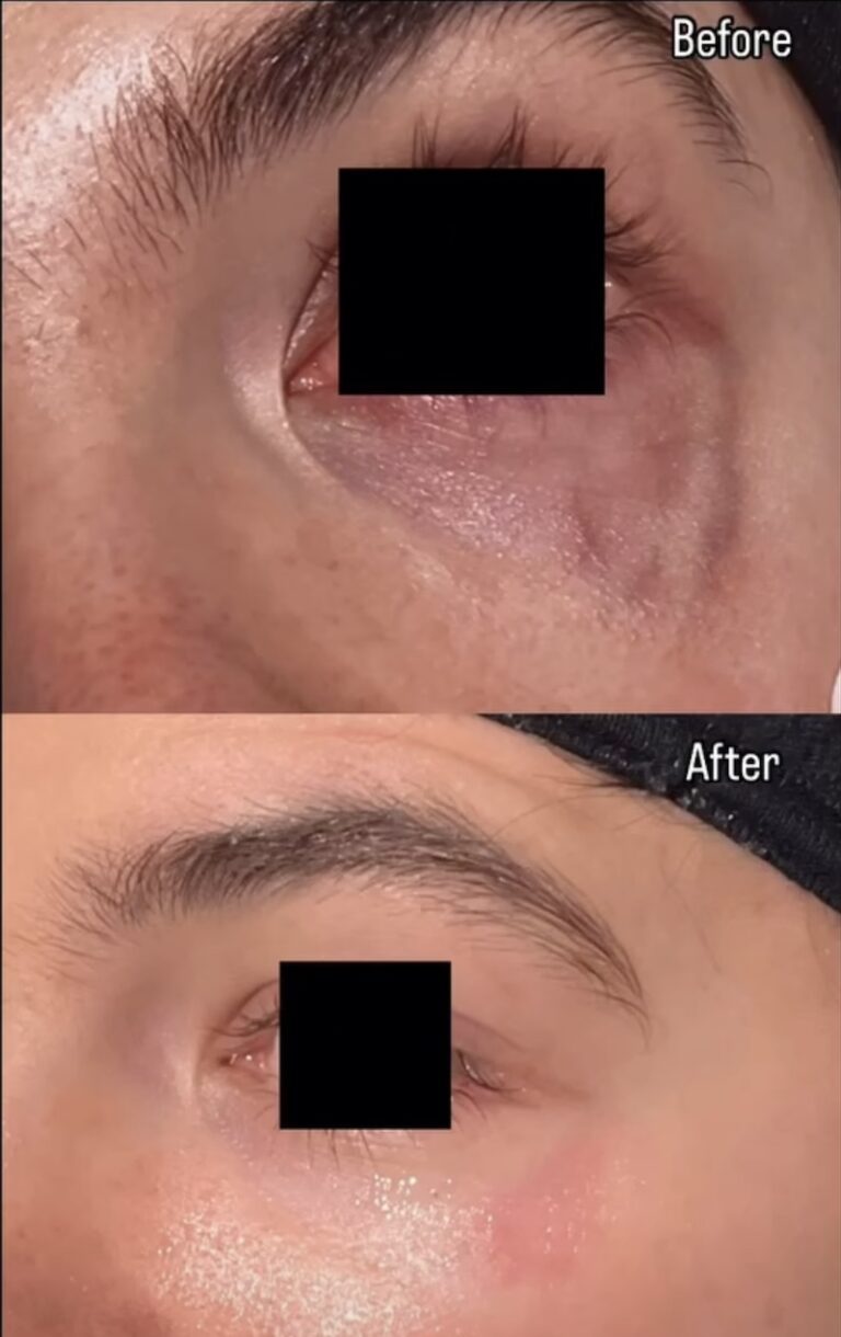 Periorbital Vein Removal In Birmingham before and after, vein removal, eye vein removal, veins around the eyes removal, secret aesthetics birmingham, harvey nichols skin clinic birmingham, the mailbox aesthetics clinic, the mailbox skin clinic, eye clinic, aesthetics clinic birmingham, skin clinic birmingham, east midlands