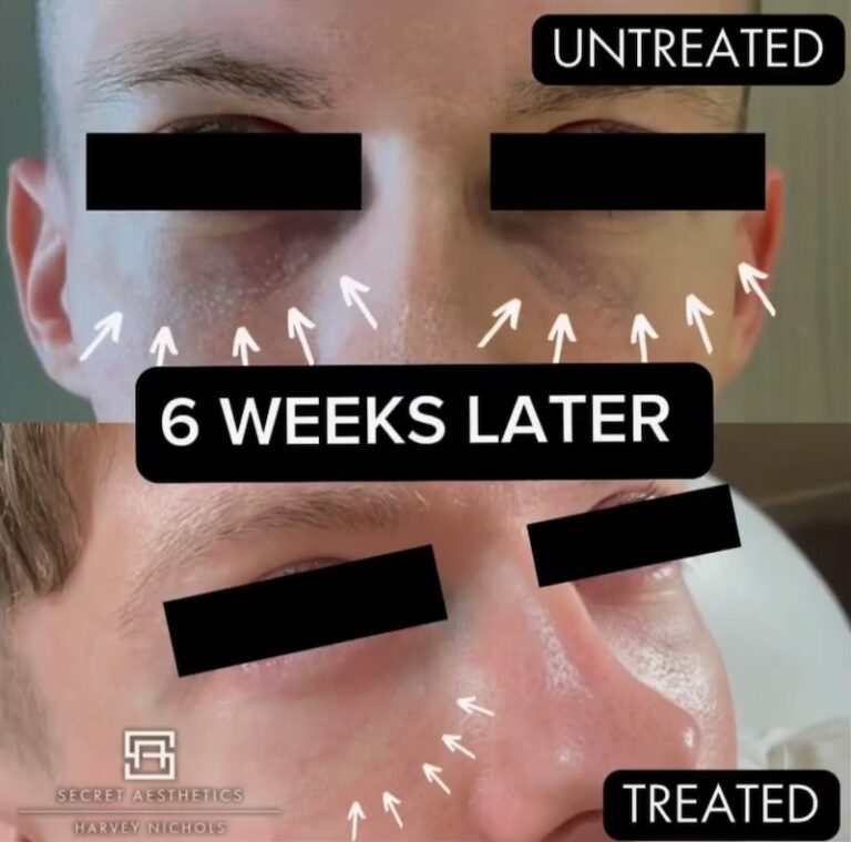 Periorbital Vein Removal In Birmingham before and after, vein removal, eye vein removal, veins around the eyes removal, secret aesthetics birmingham, harvey nichols skin clinic birmingham, the mailbox aesthetics clinic, the mailbox skin clinic, eye clinic, aesthetics clinic birmingham, skin clinic birmingham, east midlands