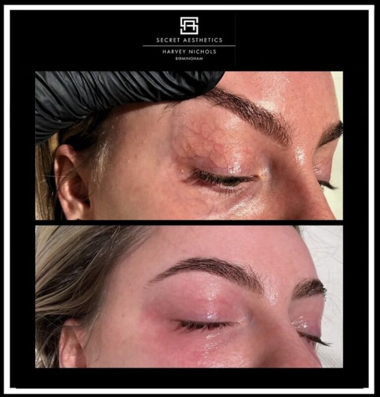 Periorbital Vein Removal In Birmingham before and after, vein removal, eye vein removal, veins around the eyes removal, secret aesthetics birmingham, harvey nichols skin clinic birmingham, the mailbox aesthetics clinic, the mailbox skin clinic, eye clinic, aesthetics clinic birmingham, skin clinic birmingham, east midlands