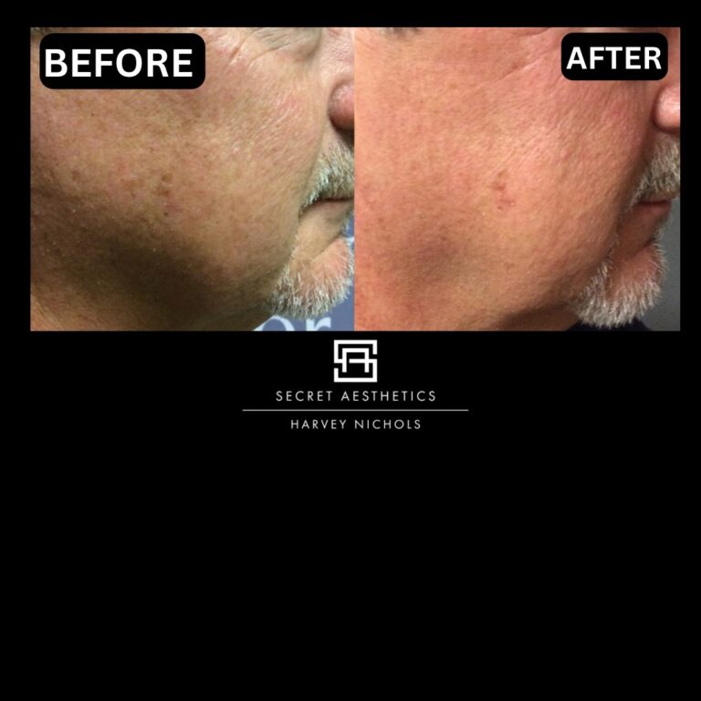 Radiofrequency microneedling results, Radiofrequency microneedling before and after, Radiofrequency microneedling treatment, Radiofrequency microneedling birmingham, aesthetics clinic birmingham, skin clinic birmingham, secret aesthetics birmingham, harvey nichols birmingham, the mailbox birmingham, the mailbox aesthetics clinic, the mailbox skin clinic, harvey nichols aesthetic clinic, harvey nichols skin clinic, General Anti-Ageing, Scars, Skin quality, laxity, texture and appearance Stretch Marks, stretch mark removal, sun damage removal, freckle removal, wrinkle treatment, skin resurfacing, scar removal