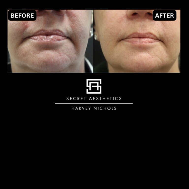 Radiofrequency microneedling results, Radiofrequency microneedling before and after, Radiofrequency microneedling treatment, Radiofrequency microneedling birmingham, aesthetics clinic birmingham, skin clinic birmingham, secret aesthetics birmingham, harvey nichols birmingham, the mailbox birmingham, the mailbox aesthetics clinic, the mailbox skin clinic, harvey nichols aesthetic clinic, harvey nichols skin clinic, General Anti-Ageing, Scars, Skin quality, laxity, texture and appearance Stretch Marks, stretch mark removal, sun damage removal, freckle removal, wrinkle treatment, skin resurfacing, scar removal