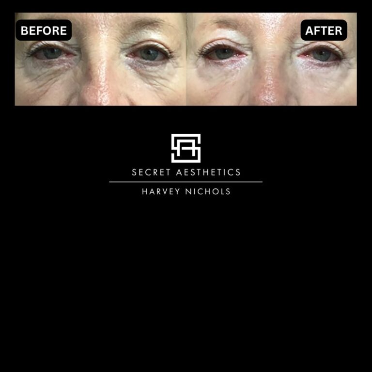 Radiofrequency microneedling results, Radiofrequency microneedling before and after, Radiofrequency microneedling treatment, Radiofrequency microneedling birmingham, aesthetics clinic birmingham, skin clinic birmingham, secret aesthetics birmingham, harvey nichols birmingham, the mailbox birmingham, the mailbox aesthetics clinic, the mailbox skin clinic, harvey nichols aesthetic clinic, harvey nichols skin clinic, General Anti-Ageing, Scars, Skin quality, laxity, texture and appearance Stretch Marks, stretch mark removal, sun damage removal, freckle removal, wrinkle treatment, skin resurfacing, scar removal