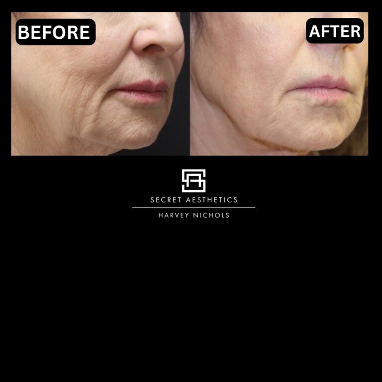 Radiofrequency microneedling results, Radiofrequency microneedling before and after, Radiofrequency microneedling treatment, Radiofrequency microneedling birmingham, aesthetics clinic birmingham, skin clinic birmingham, secret aesthetics birmingham, harvey nichols birmingham, the mailbox birmingham, the mailbox aesthetics clinic, the mailbox skin clinic, harvey nichols aesthetic clinic, harvey nichols skin clinic, General Anti-Ageing, Scars, Skin quality, laxity, texture and appearance Stretch Marks, stretch mark removal, sun damage removal, freckle removal, wrinkle treatment, skin resurfacing, scar removal