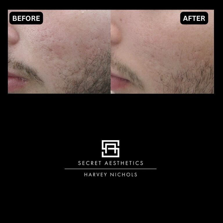 Radiofrequency microneedling results, Radiofrequency microneedling before and after, Radiofrequency microneedling treatment, Radiofrequency microneedling birmingham, aesthetics clinic birmingham, skin clinic birmingham, secret aesthetics birmingham, harvey nichols birmingham, the mailbox birmingham, the mailbox aesthetics clinic, the mailbox skin clinic, harvey nichols aesthetic clinic, harvey nichols skin clinic, General Anti-Ageing, Scars, Skin quality, laxity, texture and appearance Stretch Marks, stretch mark removal, sun damage removal, freckle removal, wrinkle treatment, skin resurfacing, scar removal