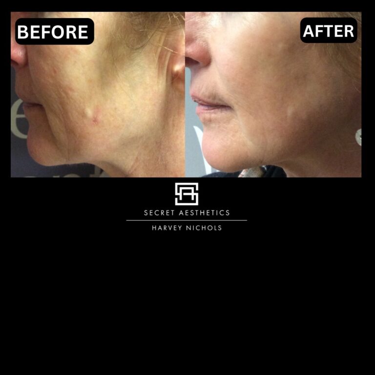 Radiofrequency microneedling results, Radiofrequency microneedling before and after, Radiofrequency microneedling treatment, Radiofrequency microneedling birmingham, aesthetics clinic birmingham, skin clinic birmingham, secret aesthetics birmingham, harvey nichols birmingham, the mailbox birmingham, the mailbox aesthetics clinic, the mailbox skin clinic, harvey nichols aesthetic clinic, harvey nichols skin clinic, General Anti-Ageing, Scars, Skin quality, laxity, texture and appearance Stretch Marks, stretch mark removal, sun damage removal, freckle removal, wrinkle treatment, skin resurfacing, scar removal