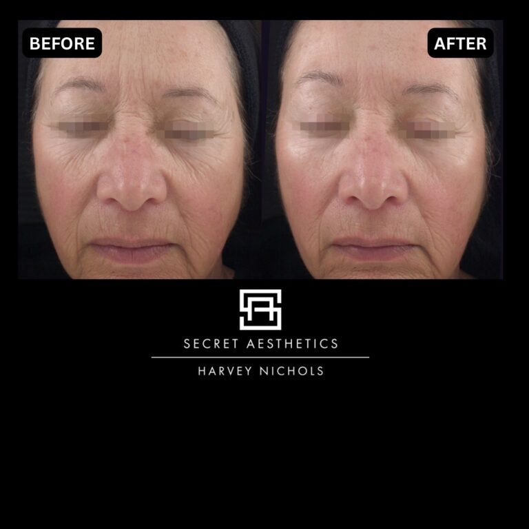 Radiofrequency microneedling results, Radiofrequency microneedling before and after, Radiofrequency microneedling treatment, Radiofrequency microneedling birmingham, aesthetics clinic birmingham, skin clinic birmingham, secret aesthetics birmingham, harvey nichols birmingham, the mailbox birmingham, the mailbox aesthetics clinic, the mailbox skin clinic, harvey nichols aesthetic clinic, harvey nichols skin clinic, General Anti-Ageing, Scars, Skin quality, laxity, texture and appearance Stretch Marks, stretch mark removal, sun damage removal, freckle removal, wrinkle treatment, skin resurfacing, scar removal