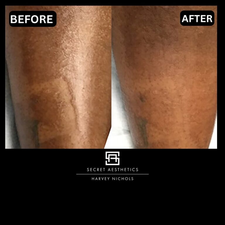 Radiofrequency microneedling results, Radiofrequency microneedling before and after, Radiofrequency microneedling treatment, Radiofrequency microneedling birmingham, aesthetics clinic birmingham, skin clinic birmingham, secret aesthetics birmingham, harvey nichols birmingham, the mailbox birmingham, the mailbox aesthetics clinic, the mailbox skin clinic, harvey nichols aesthetic clinic, harvey nichols skin clinic, General Anti-Ageing, Scars, Skin quality, laxity, texture and appearance Stretch Marks, stretch mark removal, sun damage removal, freckle removal, wrinkle treatment, skin resurfacing, scar removal