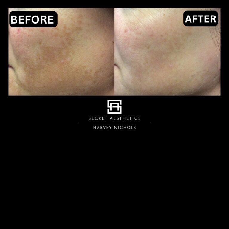 Radiofrequency microneedling results, Radiofrequency microneedling before and after, Radiofrequency microneedling treatment, Radiofrequency microneedling birmingham, aesthetics clinic birmingham, skin clinic birmingham, secret aesthetics birmingham, harvey nichols birmingham, the mailbox birmingham, the mailbox aesthetics clinic, the mailbox skin clinic, harvey nichols aesthetic clinic, harvey nichols skin clinic, General Anti-Ageing, Scars, Skin quality, laxity, texture and appearance Stretch Marks, stretch mark removal, sun damage removal, freckle removal, wrinkle treatment, skin resurfacing, scar removal