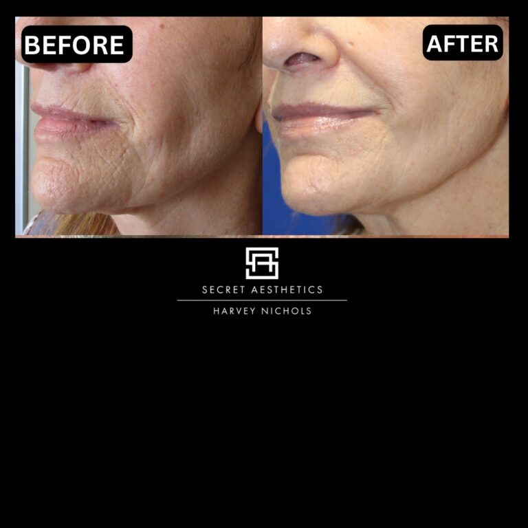 Radiofrequency microneedling results, Radiofrequency microneedling before and after, Radiofrequency microneedling treatment, Radiofrequency microneedling birmingham, aesthetics clinic birmingham, skin clinic birmingham, secret aesthetics birmingham, harvey nichols birmingham, the mailbox birmingham, the mailbox aesthetics clinic, the mailbox skin clinic, harvey nichols aesthetic clinic, harvey nichols skin clinic, General Anti-Ageing, Scars, Skin quality, laxity, texture and appearance Stretch Marks, stretch mark removal, sun damage removal, freckle removal, wrinkle treatment, skin resurfacing, scar removal