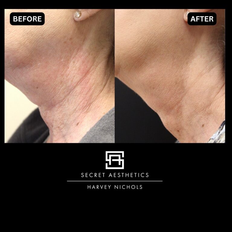 Radiofrequency microneedling results, Radiofrequency microneedling before and after, Radiofrequency microneedling treatment, Radiofrequency microneedling birmingham, aesthetics clinic birmingham, skin clinic birmingham, secret aesthetics birmingham, harvey nichols birmingham, the mailbox birmingham, the mailbox aesthetics clinic, the mailbox skin clinic, harvey nichols aesthetic clinic, harvey nichols skin clinic, General Anti-Ageing, Scars, Skin quality, laxity, texture and appearance Stretch Marks, stretch mark removal, sun damage removal, freckle removal, wrinkle treatment, skin resurfacing, scar removal