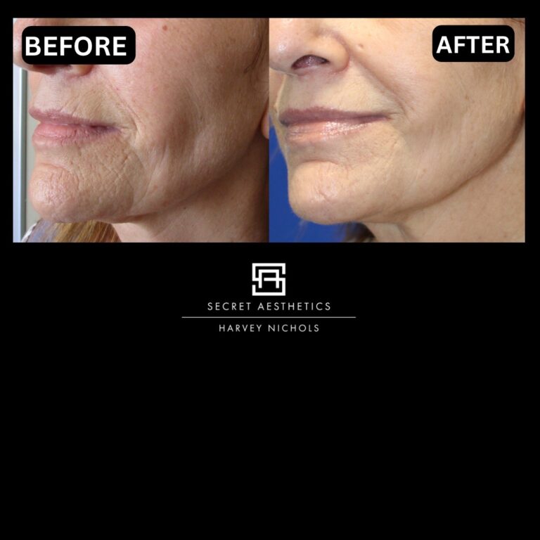 Radiofrequency microneedling results, Radiofrequency microneedling before and after, Radiofrequency microneedling treatment, Radiofrequency microneedling birmingham, aesthetics clinic birmingham, skin clinic birmingham, secret aesthetics birmingham, harvey nichols birmingham, the mailbox birmingham, the mailbox aesthetics clinic, the mailbox skin clinic, harvey nichols aesthetic clinic, harvey nichols skin clinic, General Anti-Ageing, Scars, Skin quality, laxity, texture and appearance Stretch Marks, stretch mark removal, sun damage removal, freckle removal, wrinkle treatment, skin resurfacing, scar removal