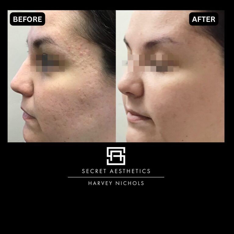 Radiofrequency microneedling results, Radiofrequency microneedling before and after, Radiofrequency microneedling treatment, Radiofrequency microneedling birmingham, aesthetics clinic birmingham, skin clinic birmingham, secret aesthetics birmingham, harvey nichols birmingham, the mailbox birmingham, the mailbox aesthetics clinic, the mailbox skin clinic, harvey nichols aesthetic clinic, harvey nichols skin clinic, General Anti-Ageing, Scars, Skin quality, laxity, texture and appearance Stretch Marks, stretch mark removal, sun damage removal, freckle removal, wrinkle treatment, skin resurfacing, scar removal