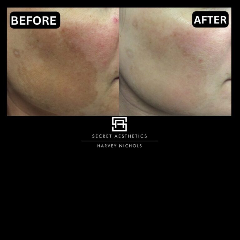 Radiofrequency microneedling results, Radiofrequency microneedling before and after, Radiofrequency microneedling treatment, Radiofrequency microneedling birmingham, aesthetics clinic birmingham, skin clinic birmingham, secret aesthetics birmingham, harvey nichols birmingham, the mailbox birmingham, the mailbox aesthetics clinic, the mailbox skin clinic, harvey nichols aesthetic clinic, harvey nichols skin clinic, General Anti-Ageing, Scars, Skin quality, laxity, texture and appearance Stretch Marks, stretch mark removal, sun damage removal, freckle removal, wrinkle treatment, skin resurfacing, scar removal