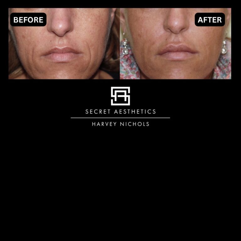 Radiofrequency microneedling results, Radiofrequency microneedling before and after, Radiofrequency microneedling treatment, Radiofrequency microneedling birmingham, aesthetics clinic birmingham, skin clinic birmingham, secret aesthetics birmingham, harvey nichols birmingham, the mailbox birmingham, the mailbox aesthetics clinic, the mailbox skin clinic, harvey nichols aesthetic clinic, harvey nichols skin clinic, General Anti-Ageing, Scars, Skin quality, laxity, texture and appearance Stretch Marks, stretch mark removal, sun damage removal, freckle removal, wrinkle treatment, skin resurfacing, scar removal