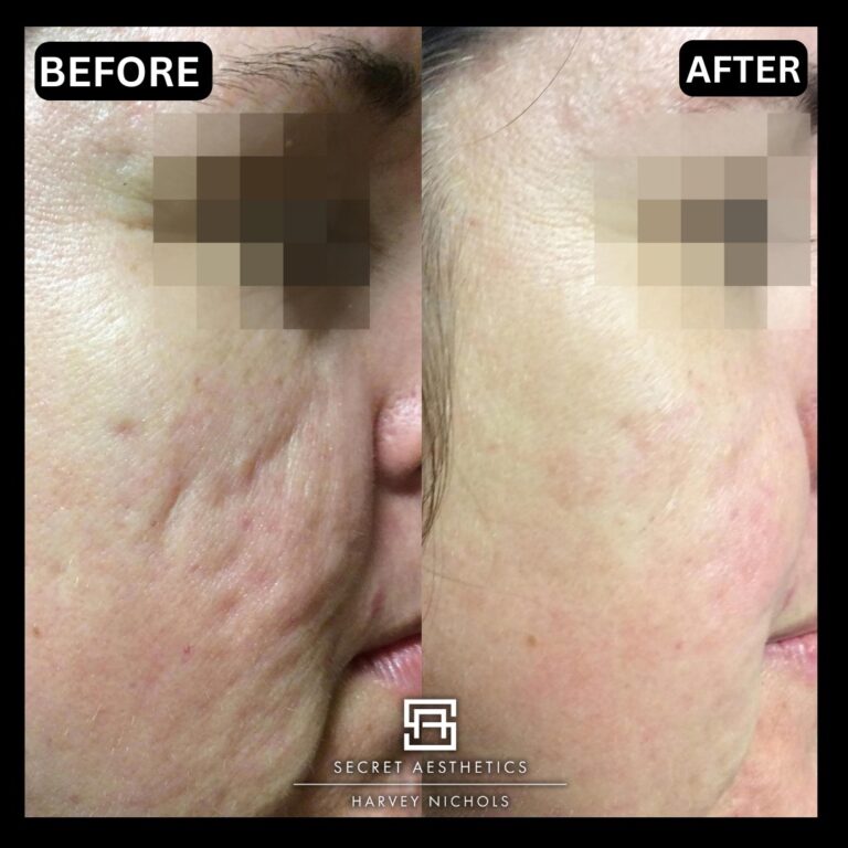 Radiofrequency microneedling results, Radiofrequency microneedling before and after, Radiofrequency microneedling treatment, Radiofrequency microneedling birmingham, aesthetics clinic birmingham, skin clinic birmingham, secret aesthetics birmingham, harvey nichols birmingham, the mailbox birmingham, the mailbox aesthetics clinic, the mailbox skin clinic, harvey nichols aesthetic clinic, harvey nichols skin clinic, General Anti-Ageing, Scars, Skin quality, laxity, texture and appearance Stretch Marks, stretch mark removal, sun damage removal, freckle removal, wrinkle treatment, skin resurfacing, scar removal
