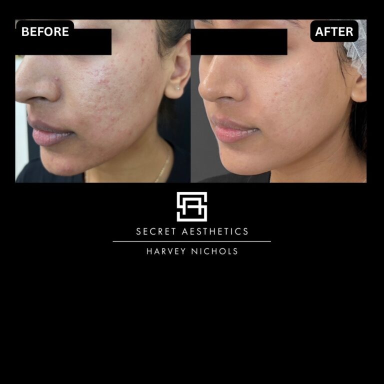 Radiofrequency microneedling results, Radiofrequency microneedling before and after, Radiofrequency microneedling treatment, Radiofrequency microneedling birmingham, aesthetics clinic birmingham, skin clinic birmingham, secret aesthetics birmingham, harvey nichols birmingham, the mailbox birmingham, the mailbox aesthetics clinic, the mailbox skin clinic, harvey nichols aesthetic clinic, harvey nichols skin clinic, General Anti-Ageing, Scars, Skin quality, laxity, texture and appearance Stretch Marks, stretch mark removal, sun damage removal, freckle removal, wrinkle treatment, skin resurfacing, scar removal