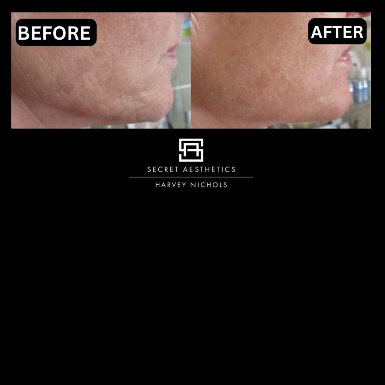 Radiofrequency microneedling results, Radiofrequency microneedling before and after, Radiofrequency microneedling treatment, Radiofrequency microneedling birmingham, aesthetics clinic birmingham, skin clinic birmingham, secret aesthetics birmingham, harvey nichols birmingham, the mailbox birmingham, the mailbox aesthetics clinic, the mailbox skin clinic, harvey nichols aesthetic clinic, harvey nichols skin clinic, General Anti-Ageing, Scars, Skin quality, laxity, texture and appearance Stretch Marks, stretch mark removal, sun damage removal, freckle removal, wrinkle treatment, skin resurfacing, scar removal