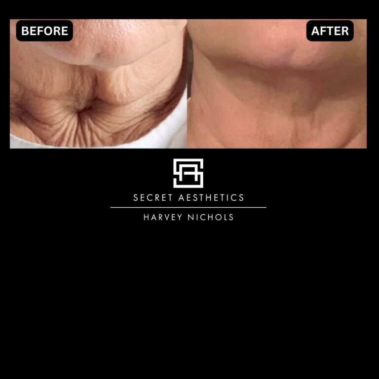 Radiofrequency microneedling results, Radiofrequency microneedling before and after, Radiofrequency microneedling treatment, Radiofrequency microneedling birmingham, aesthetics clinic birmingham, skin clinic birmingham, secret aesthetics birmingham, harvey nichols birmingham, the mailbox birmingham, the mailbox aesthetics clinic, the mailbox skin clinic, harvey nichols aesthetic clinic, harvey nichols skin clinic, General Anti-Ageing, Scars, Skin quality, laxity, texture and appearance Stretch Marks, stretch mark removal, sun damage removal, freckle removal, wrinkle treatment, skin resurfacing, scar removal