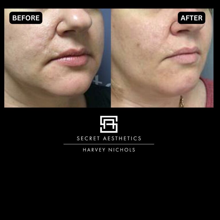 Radiofrequency microneedling results, Radiofrequency microneedling before and after, Radiofrequency microneedling treatment, Radiofrequency microneedling birmingham, aesthetics clinic birmingham, skin clinic birmingham, secret aesthetics birmingham, harvey nichols birmingham, the mailbox birmingham, the mailbox aesthetics clinic, the mailbox skin clinic, harvey nichols aesthetic clinic, harvey nichols skin clinic, General Anti-Ageing, Scars, Skin quality, laxity, texture and appearance Stretch Marks, stretch mark removal, sun damage removal, freckle removal, wrinkle treatment, skin resurfacing, scar removal