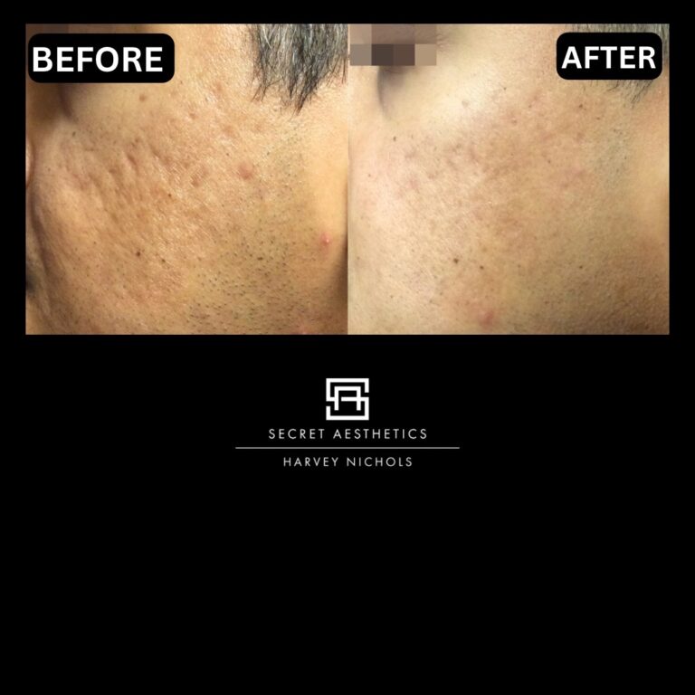 Radiofrequency microneedling results, Radiofrequency microneedling before and after, Radiofrequency microneedling treatment, Radiofrequency microneedling birmingham, aesthetics clinic birmingham, skin clinic birmingham, secret aesthetics birmingham, harvey nichols birmingham, the mailbox birmingham, the mailbox aesthetics clinic, the mailbox skin clinic, harvey nichols aesthetic clinic, harvey nichols skin clinic, General Anti-Ageing, Scars, Skin quality, laxity, texture and appearance Stretch Marks, stretch mark removal, sun damage removal, freckle removal, wrinkle treatment, skin resurfacing, scar removal